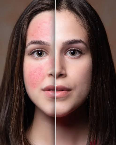 Rosacea & Redness