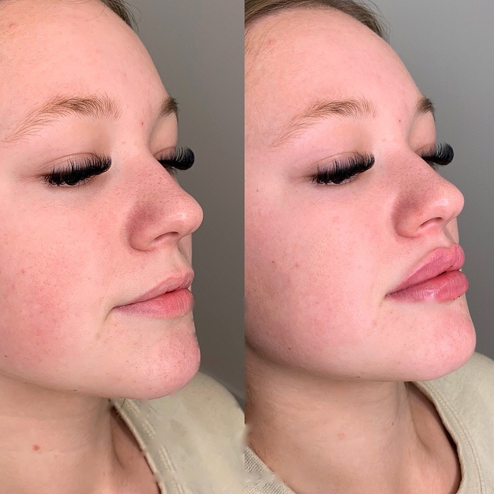 Lip Filler