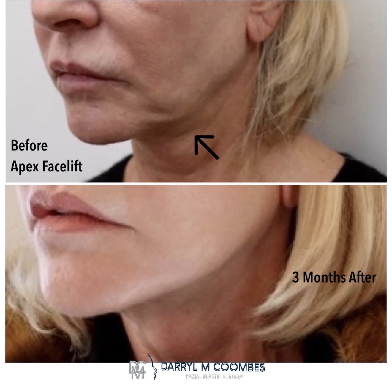 Jawline before and three months after an Apex Facelift®