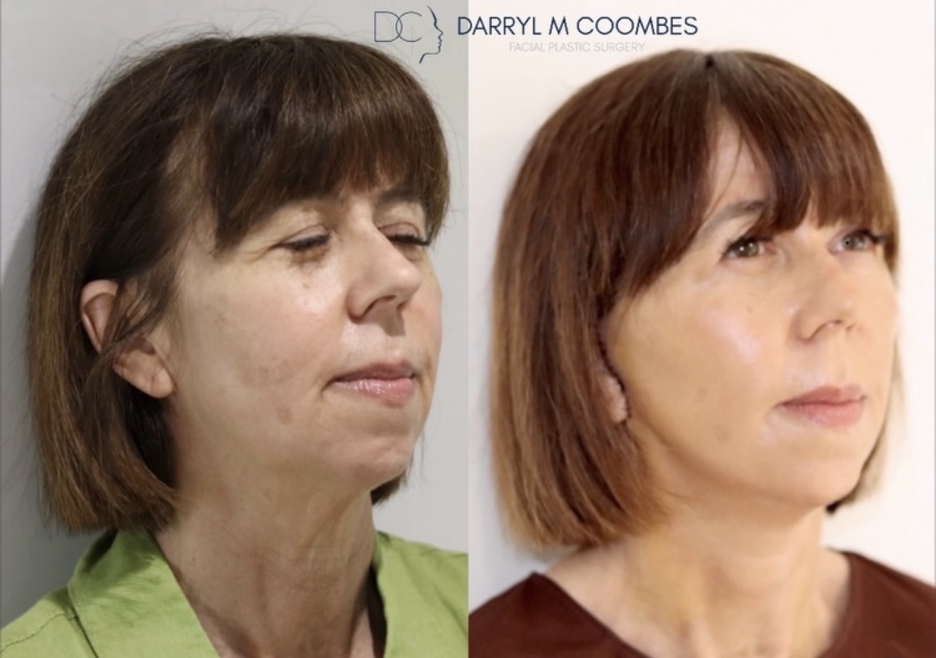Before and after an Apex Facelift®, three-quarter view