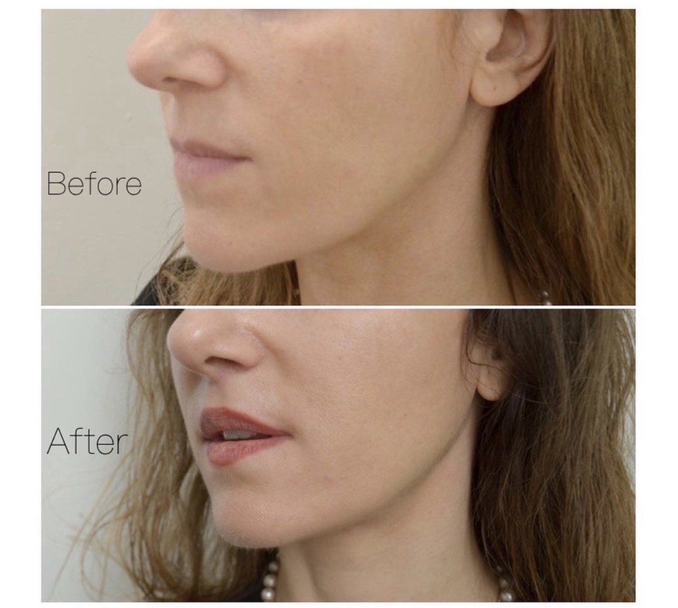 Profile before and after a lip lift
