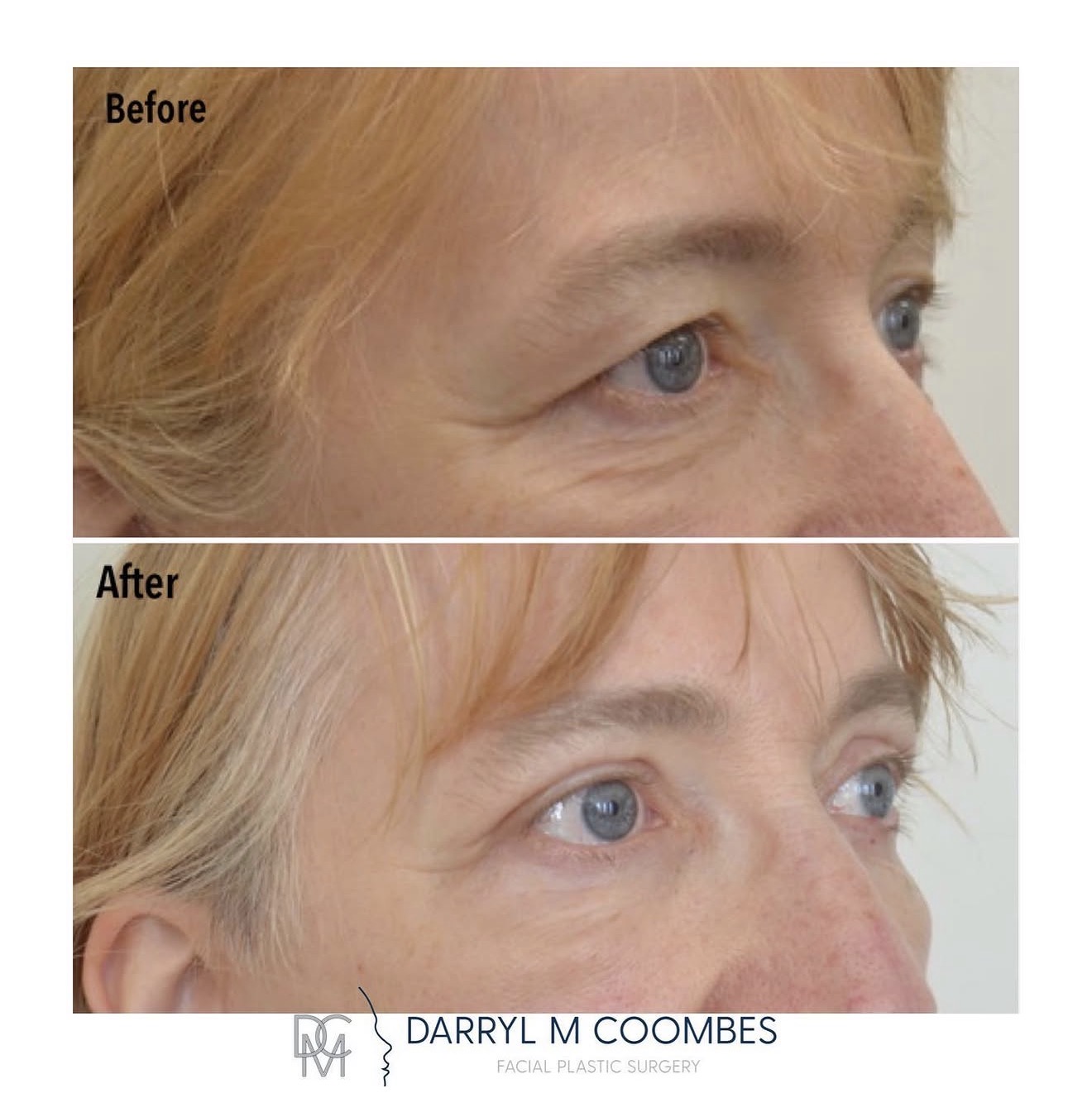 Upper eyelids before and after upper blepharoplasty