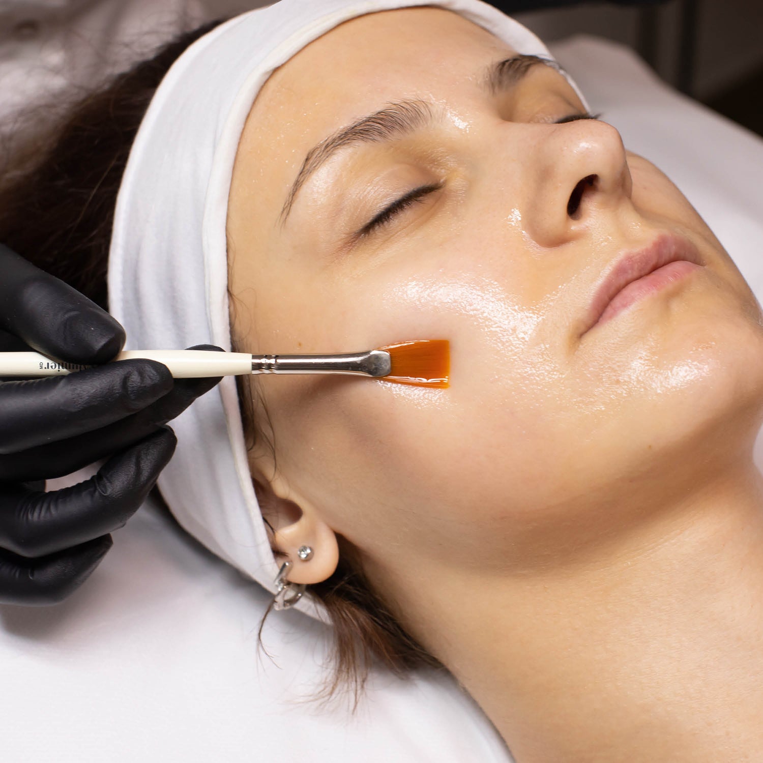 Chemical Peels