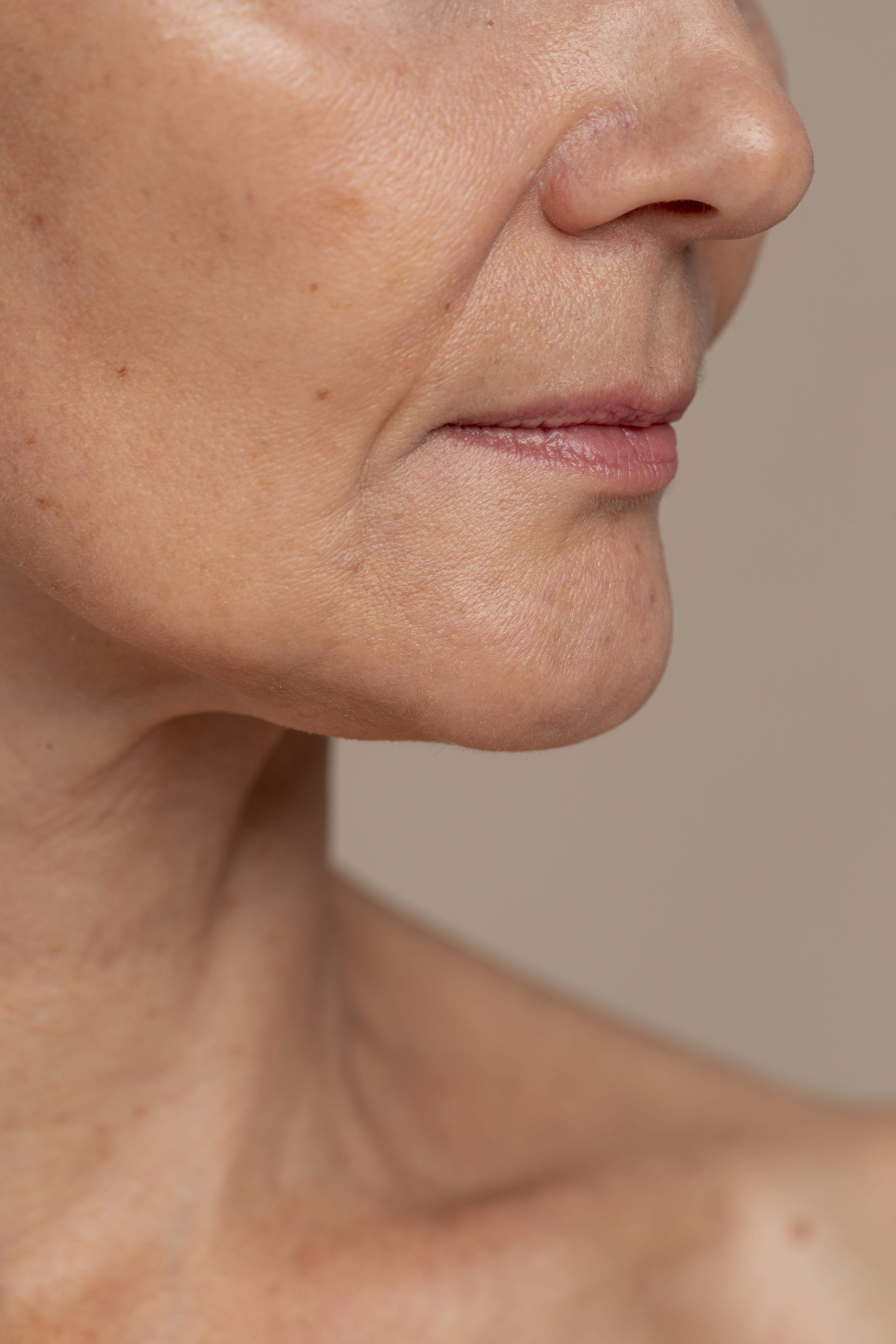 NIR Skin Tightening